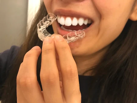 マウスピース矯正の画像