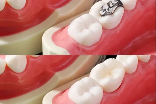 詰め物・被せ物治療