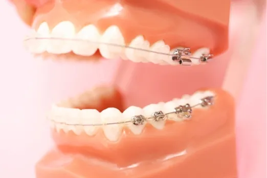 歯列矯正